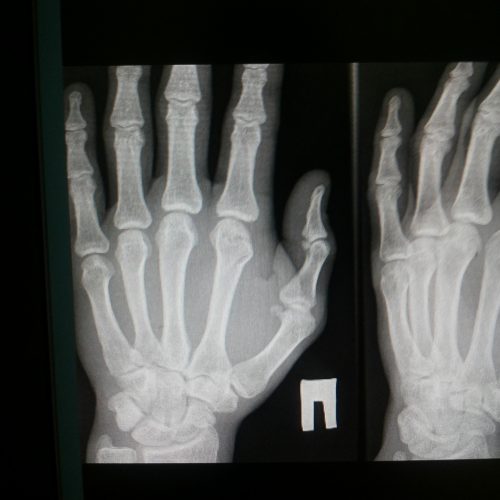Healing Joints