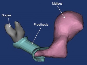 Maryland Researchers 3D Print Middle Ear Prostheses