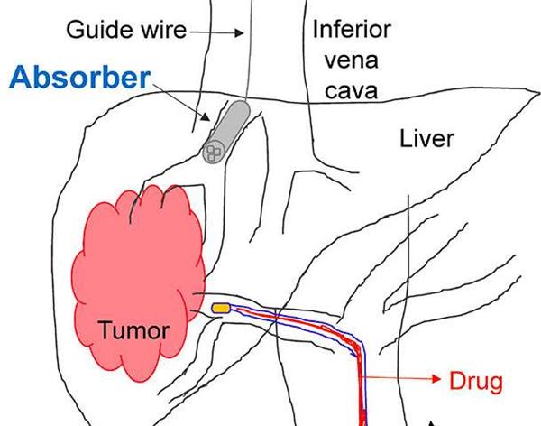 3D Printed Sponge Aids in Chemotherapy