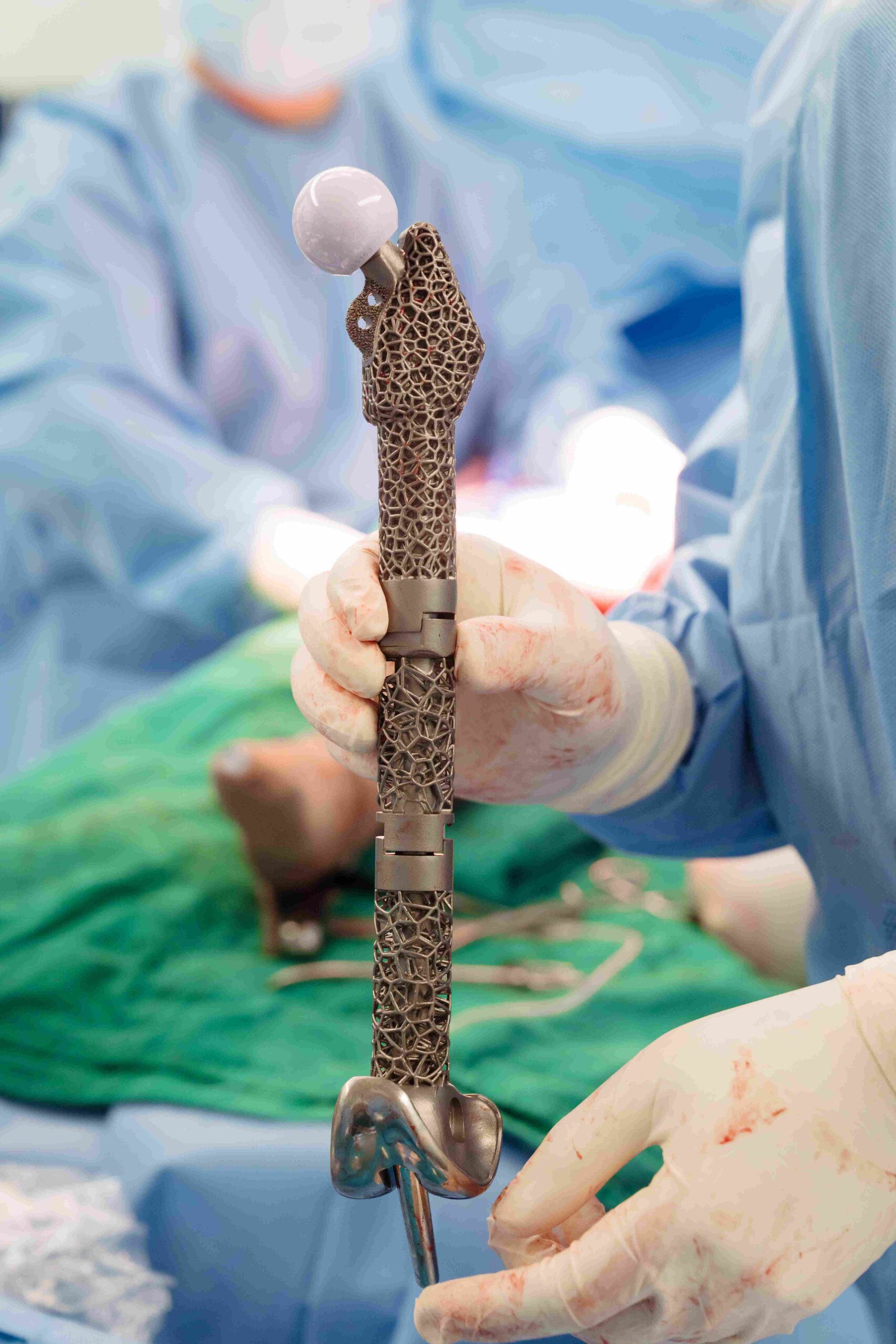 The patient-specific 3D-printed titanium total femur implant produced by Vinmec