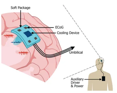 Concept drawing of an implantable system for focal brain cooling