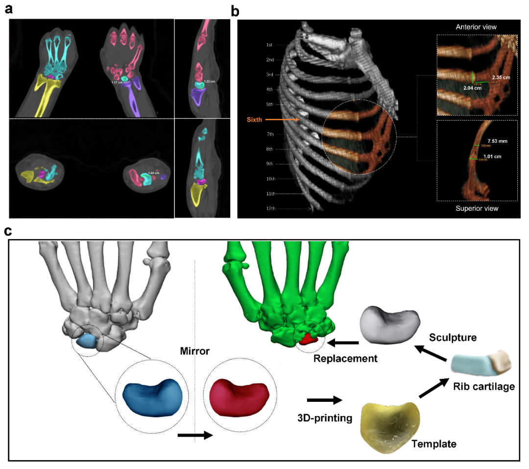 Bone replacement process