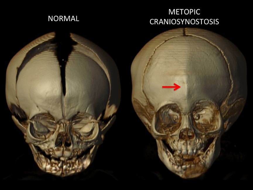 Trigonocephaly