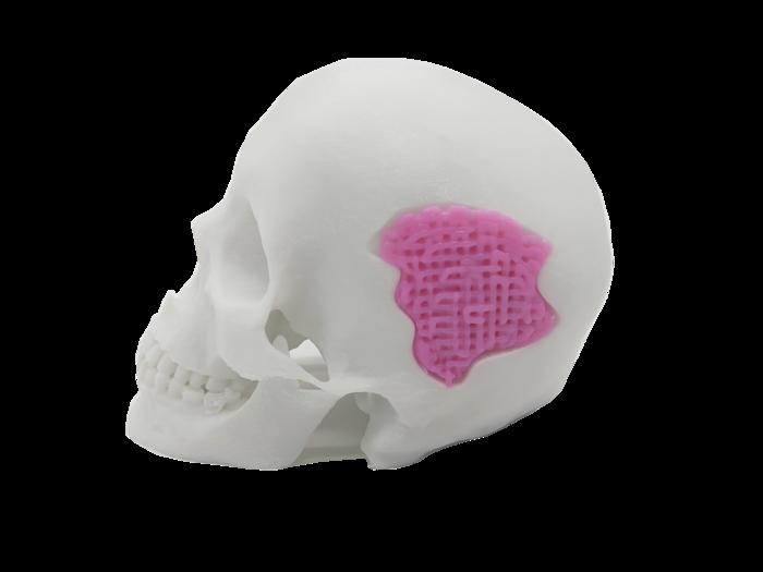 Researchers Develop 3D Printable Bio-Glass for Bone Replacement Applications