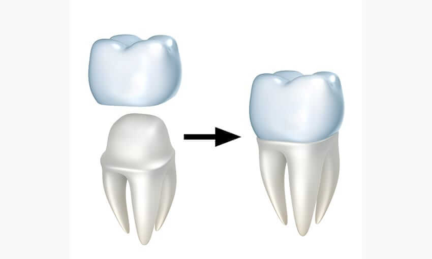 Study finds 3D is Superior for Crowns - Printing