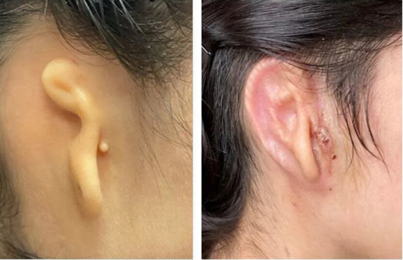 3d printed ear