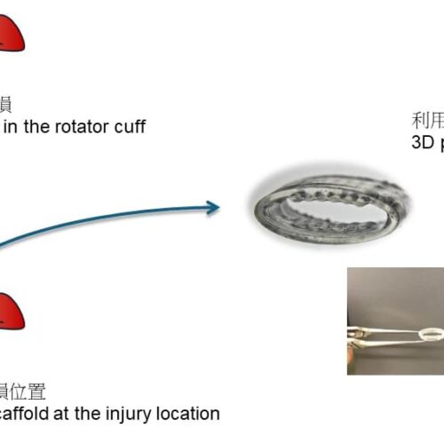 3D Printed Elastomer Aids Rotator Cuff Recovery