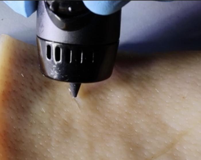 3D Printing Pen Deploys Wound-Healing Ink