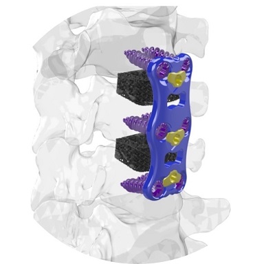 FloSpine Successfully Implants First Ti-Largo 3D Printed Cervical Cage
