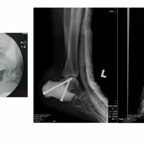 Malaysian Hospital Performs Heel Bone Replacement with 3D Printing