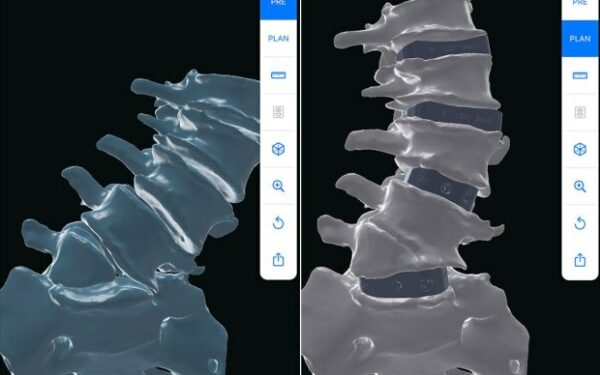 3D Printing Corrects Patient’s Spine and Adds Height