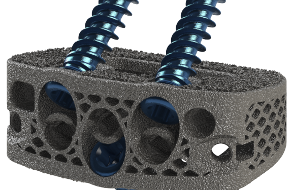 DeGen Medical Reveals 3D Printed ALIF Implant