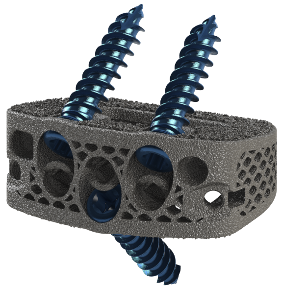 DeGen Medical Reveals 3D Printed ALIF Implant