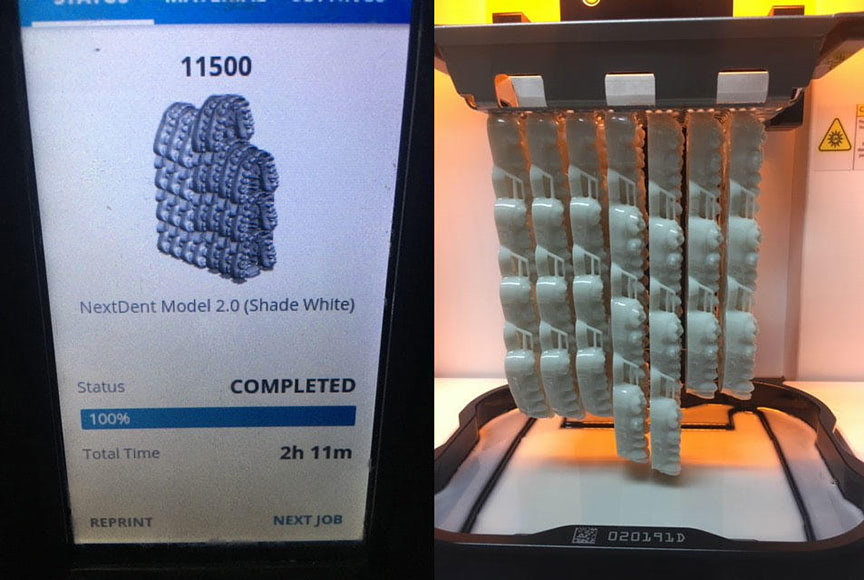 nextdent vertical stacking